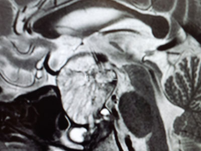 SKULL BASE OPEN AND ENDOSCOPIC SURGERIES