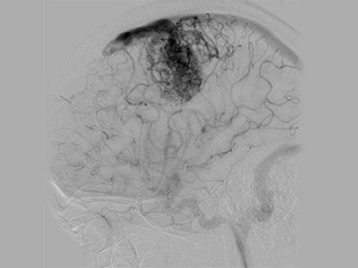 CEREBROVASCULA OPEN SURGICAL AND ENDOVASCULAR INTERVENTIONAL THERAPIES